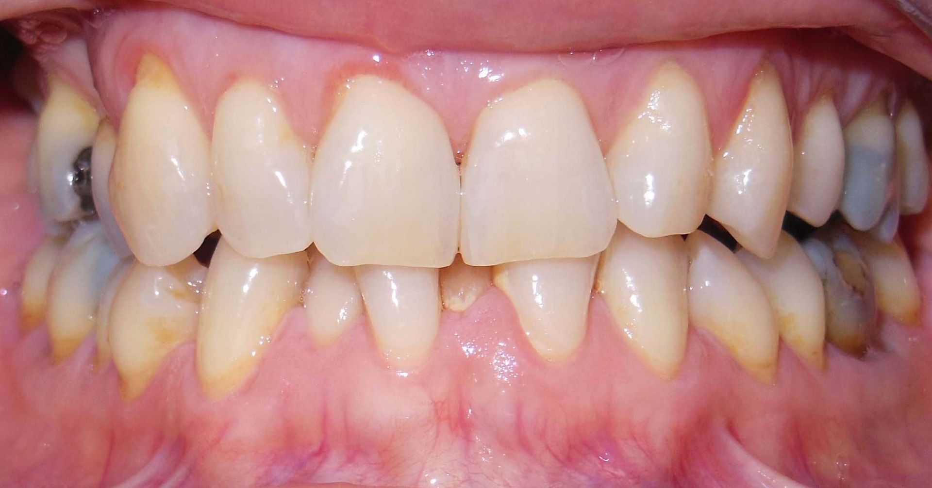 Primo piano di denti e gengive con affollamento dentale e ingiallimento visibili