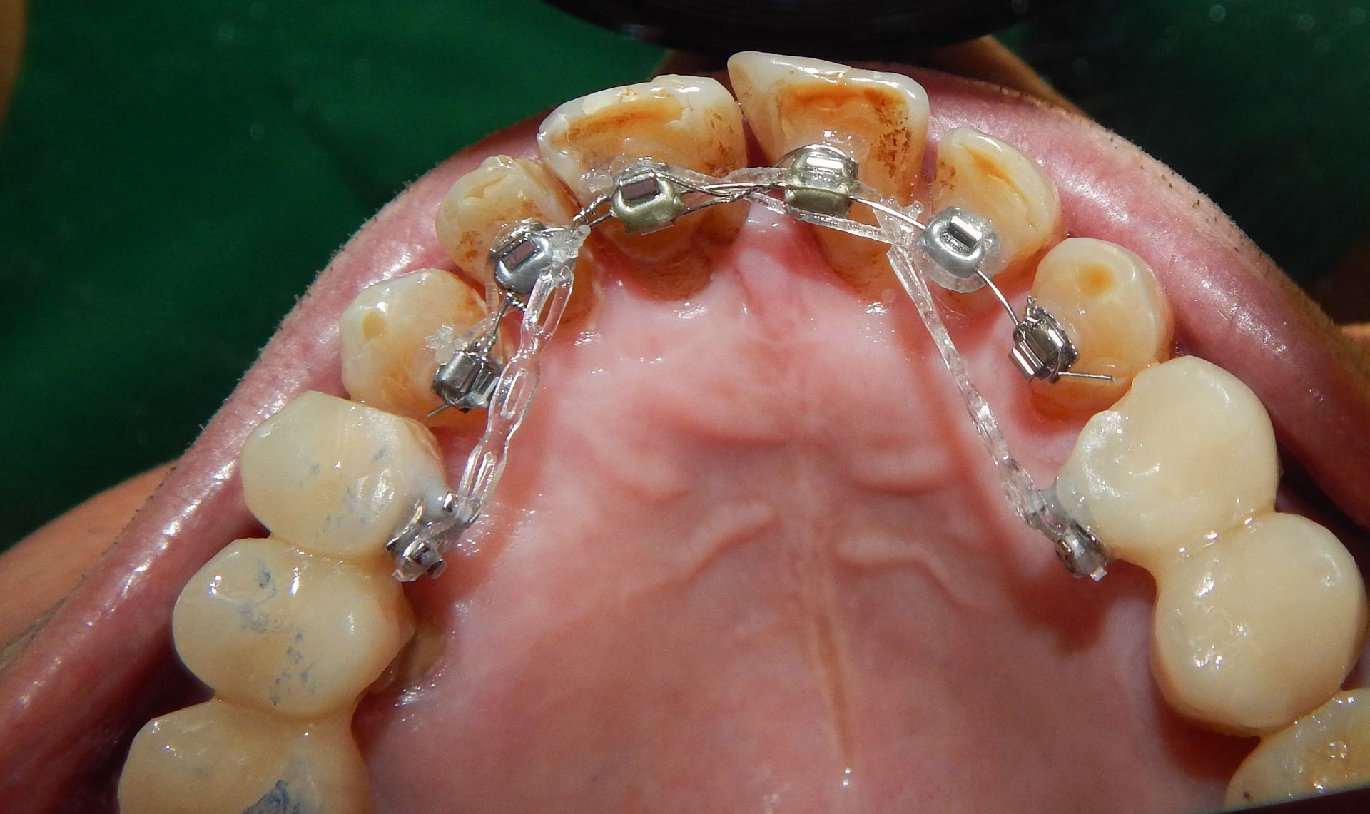 Primo piano dei denti superiori con apparecchio ortodontico metallico e un espansore palatale sul palato