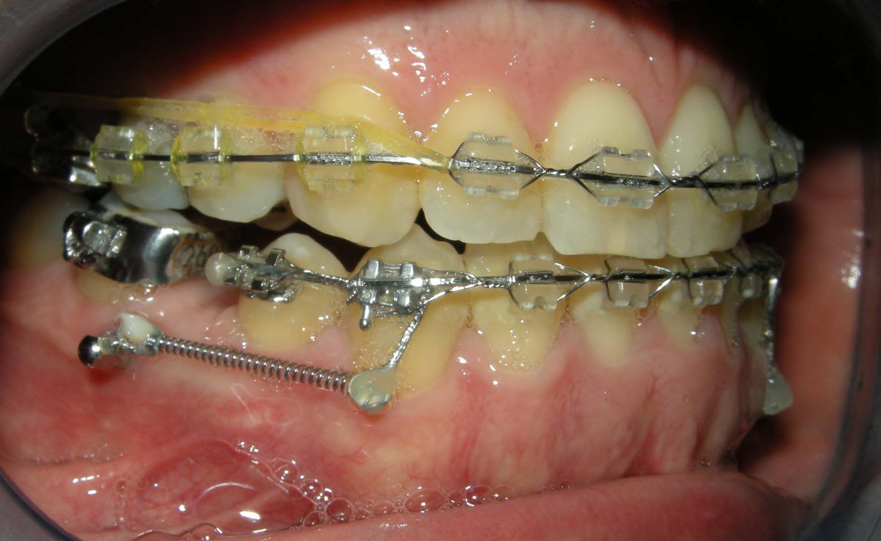 Primo piano di una bocca con apparecchio ortodontico metallico e bande ortodontiche sui denti superiori e inferiori