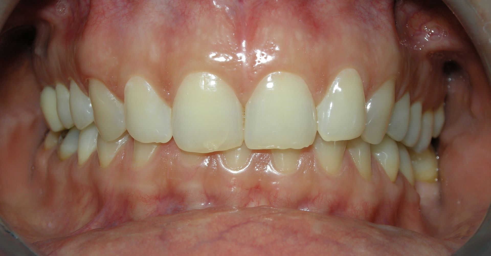 Primo piano della bocca con denti e gengive durante una visita odontoiatrica