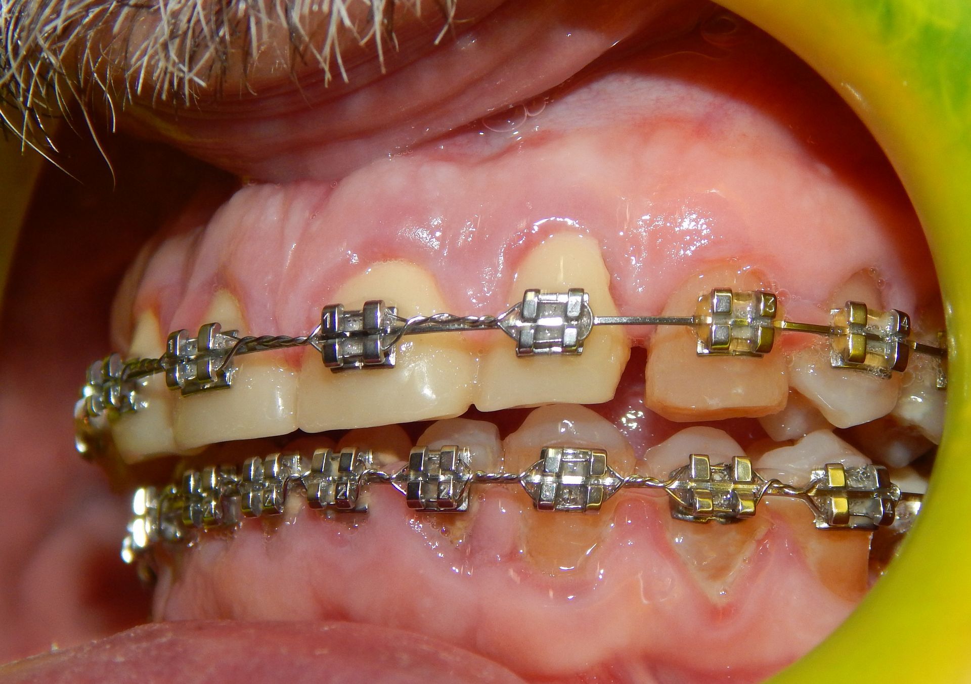 Primo piano di una bocca con l’apparecchio sui denti superiori e inferiori, con attacchi metallici e fili visibili