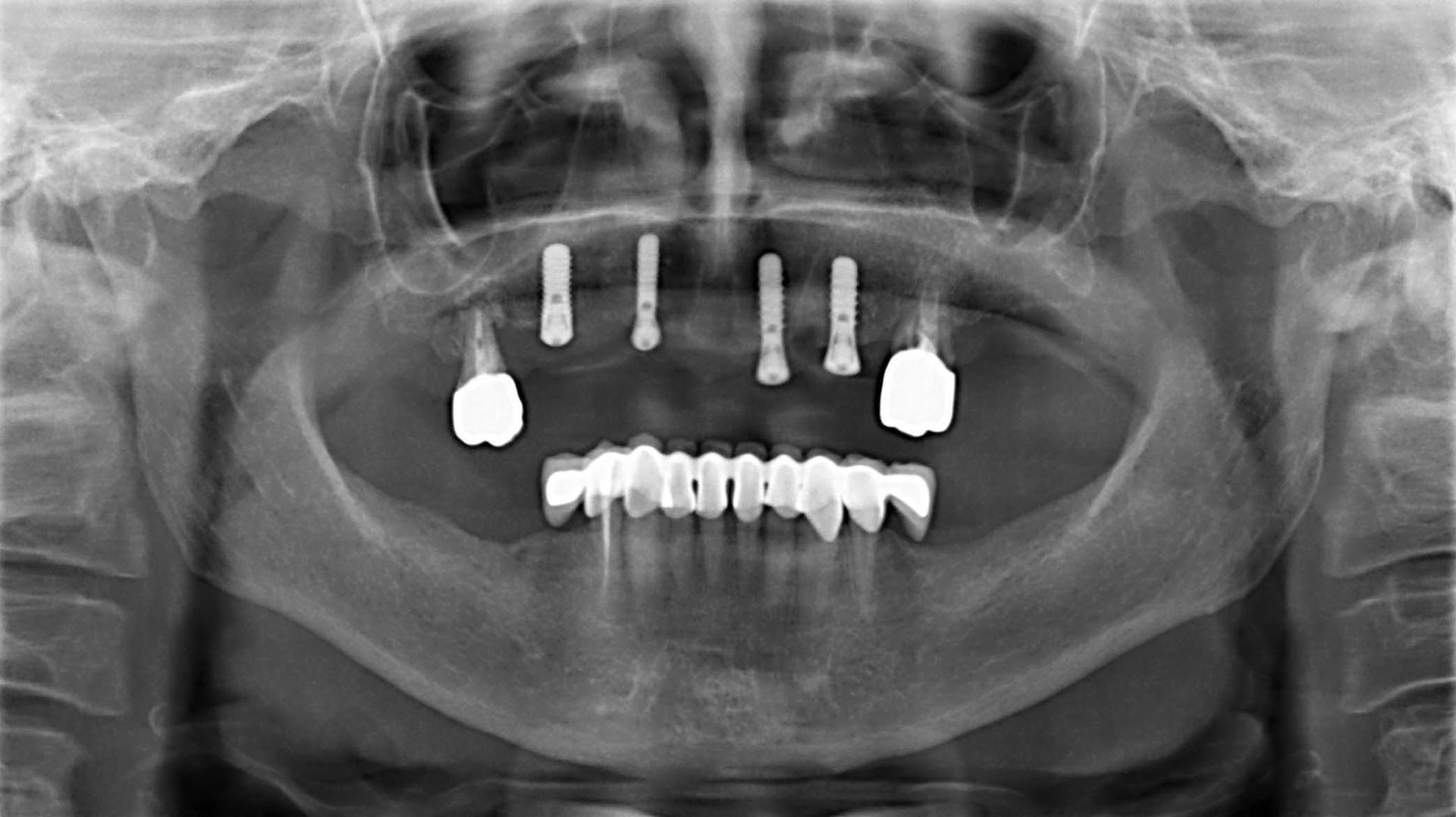 Radiografia panoramica dentale che mostra i denti superiori e inferiori con impianti e corone