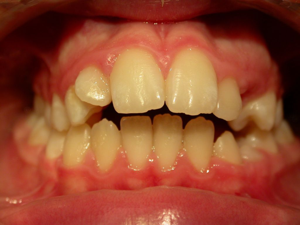Primo piano di denti affollati, con uno spazio tra gli incisivi e la linea gengivale visibile