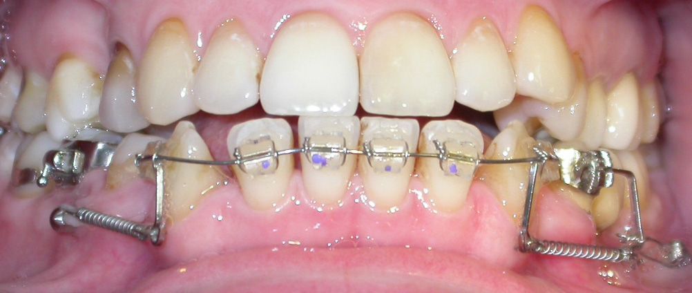 Primo piano di denti con apparecchio ortodontico e componenti, tra cui un filo metallico e attacchi.