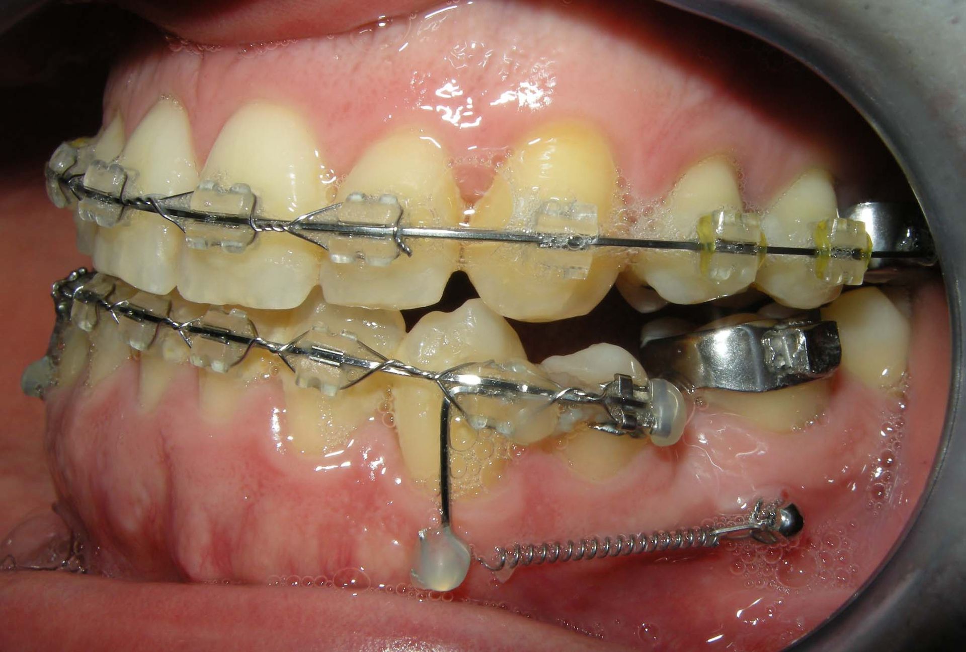 Vista laterale dei denti con apparecchio ortodontico e fili metallici, che mostra l’apparecchiatura dentale all’interno della bocca
