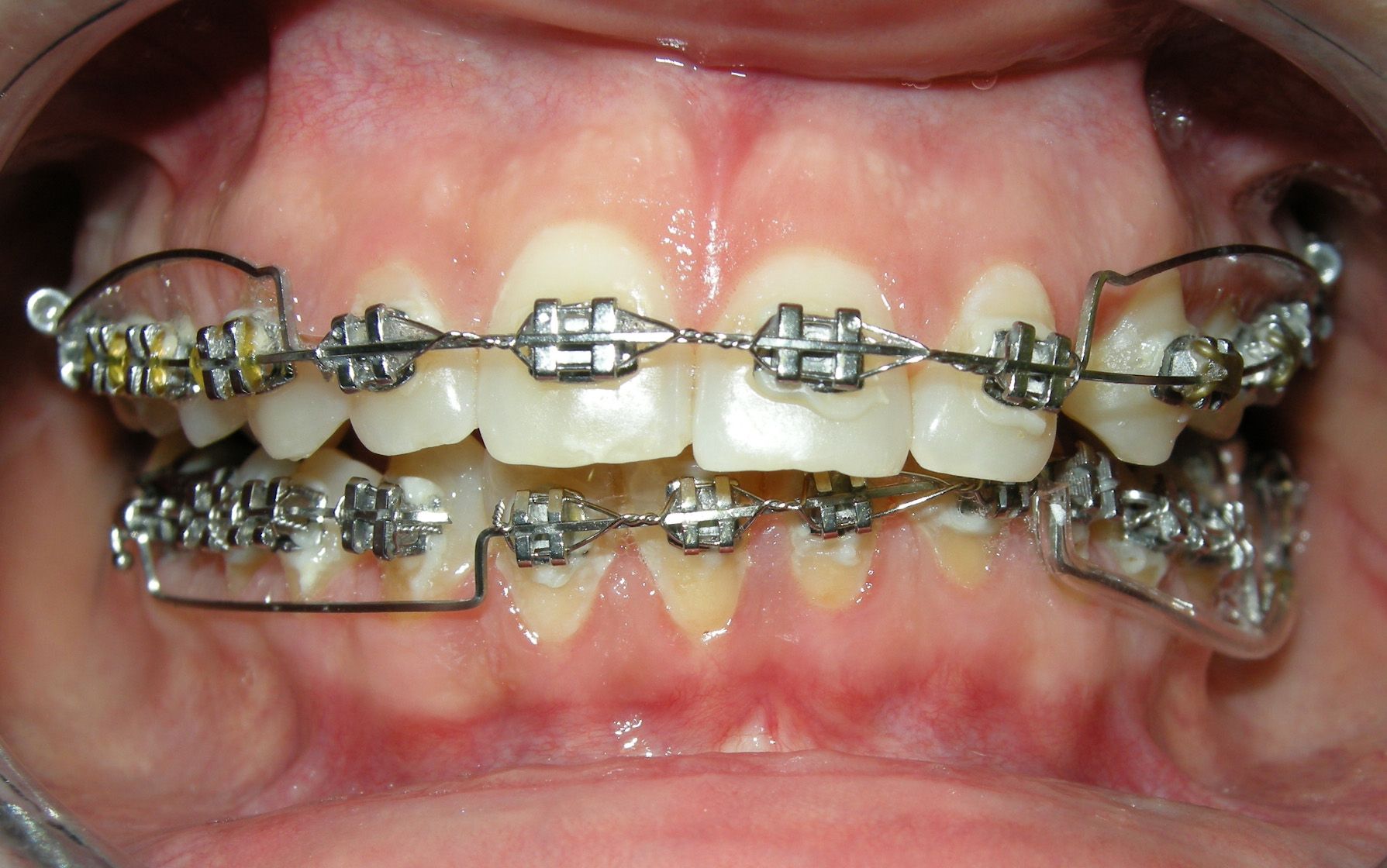 Primo piano della bocca con l’apparecchio ortodontico sui denti superiori e inferiori e i fili visibili