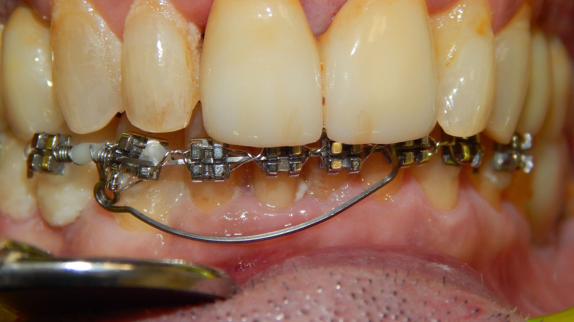 Primo piano dei denti superiori con apparecchio metallico e filo inferiore curvo