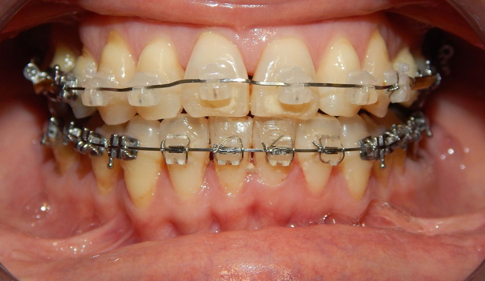 Primo piano di denti con apparecchio metallico sia sull’arcata superiore che su quella inferiore