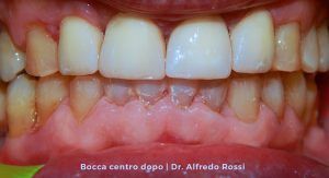 Primo piano di denti con un problema di allineamento e il tessuto gengivale visibile sotto i denti superiori