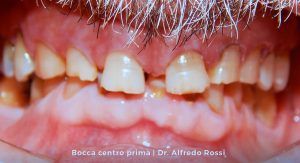 Primo piano di una bocca con denti affollati e disallineati e gengive visibili.