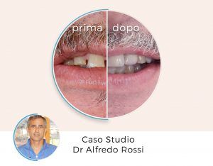 Confronto del sorriso prima e dopo il trattamento odontoiatrico, con le diciture «prima» e «dopo» e «Caso Studio Dr Alfredo Rossi» sotto
