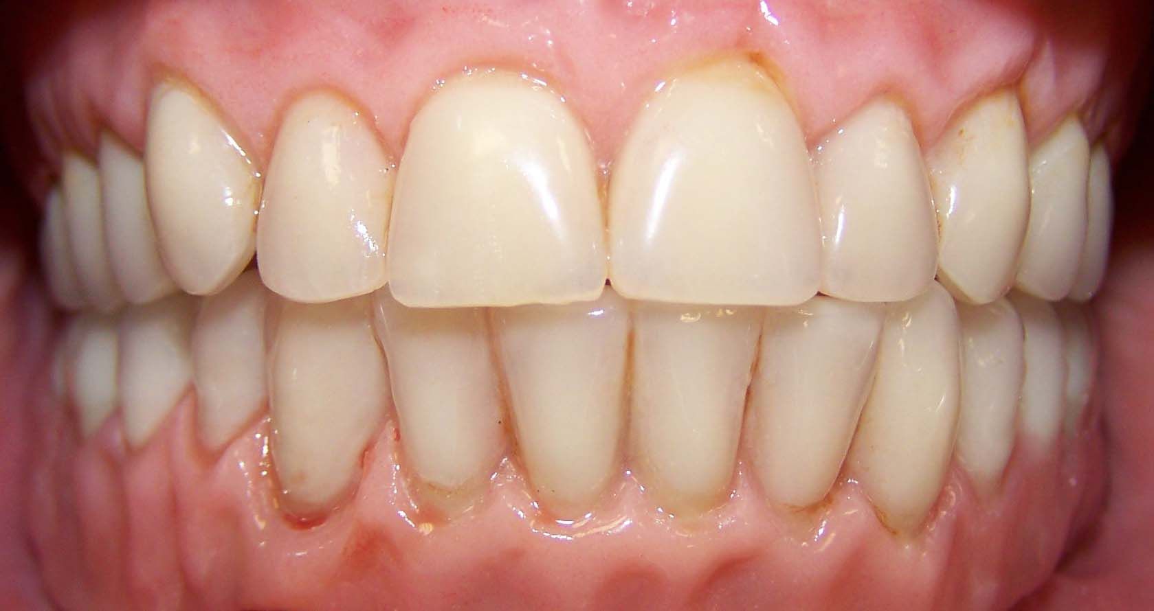 Primo piano di una bocca sorridente che mostra denti allineati e gengive rosa