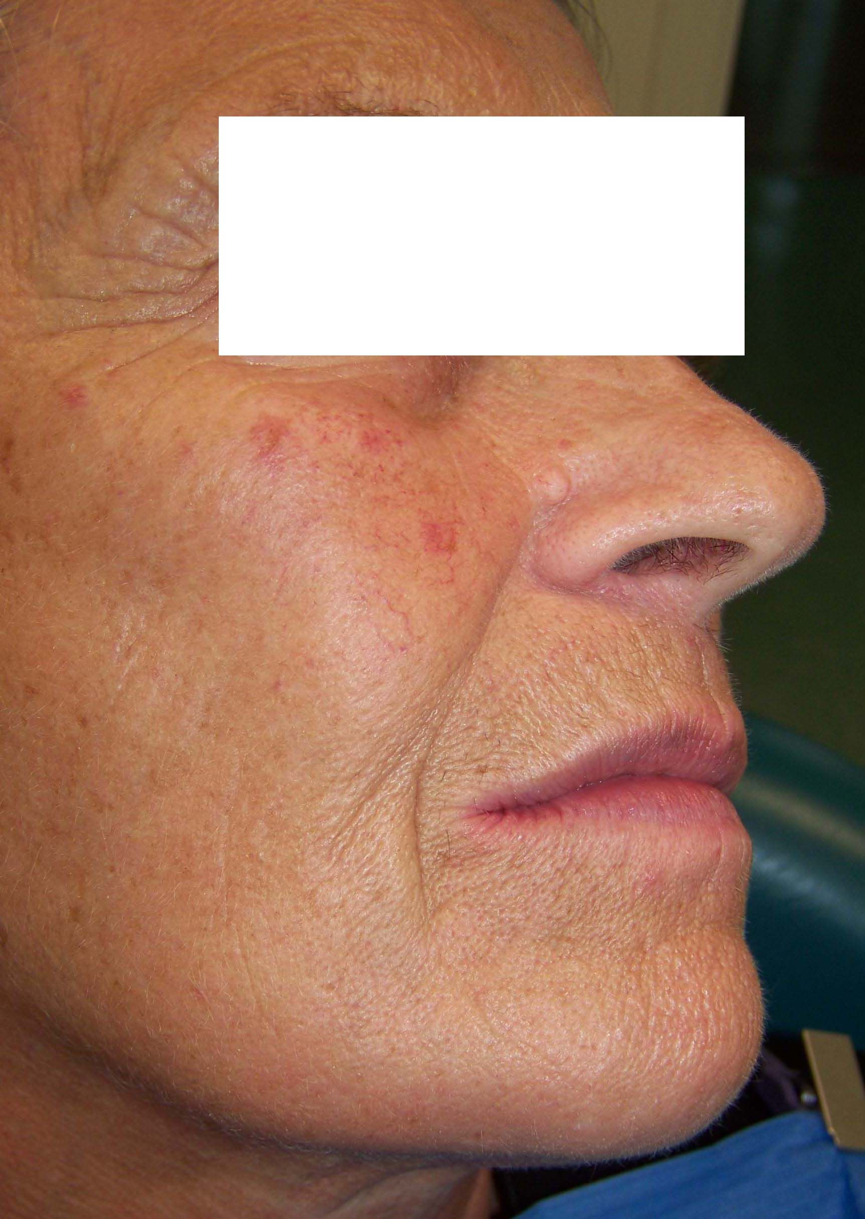 Profilo laterale di una persona con un piccolo segno rosso sulla guancia e una maschera rettangolare bianca sugli occhi