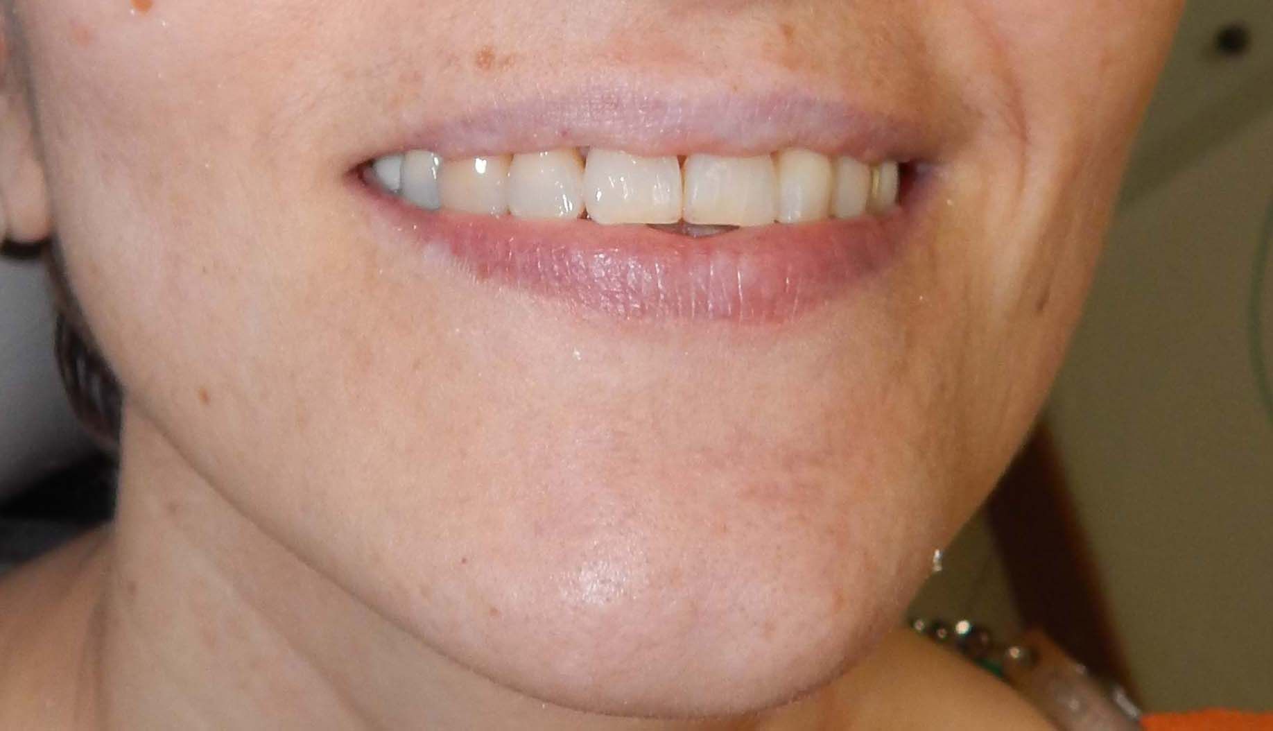 Primo piano di una bocca sorridente con i denti visibili e un dito che indica il labbro inferiore