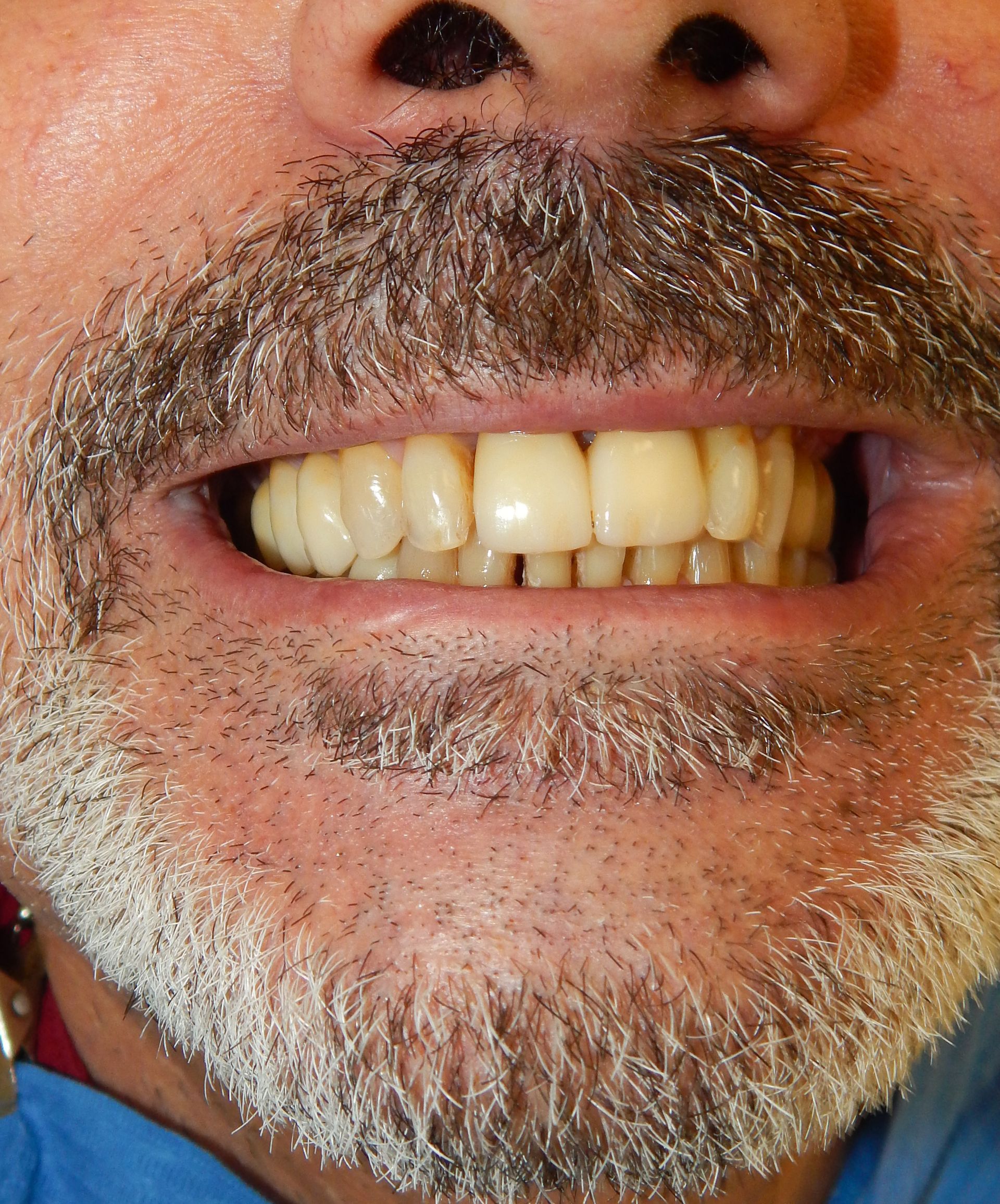 Primo piano di una bocca sorridente con baffi e barba grigi, che mostra i denti