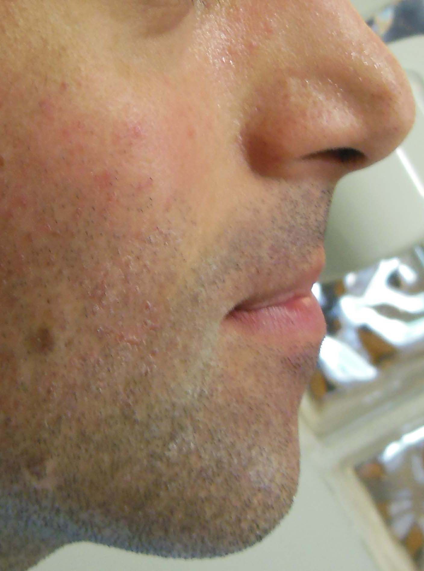 Primo piano del profilo laterale della parte inferiore del viso e del naso di un uomo, con barba incolta visibile e un lieve rossore della pelle