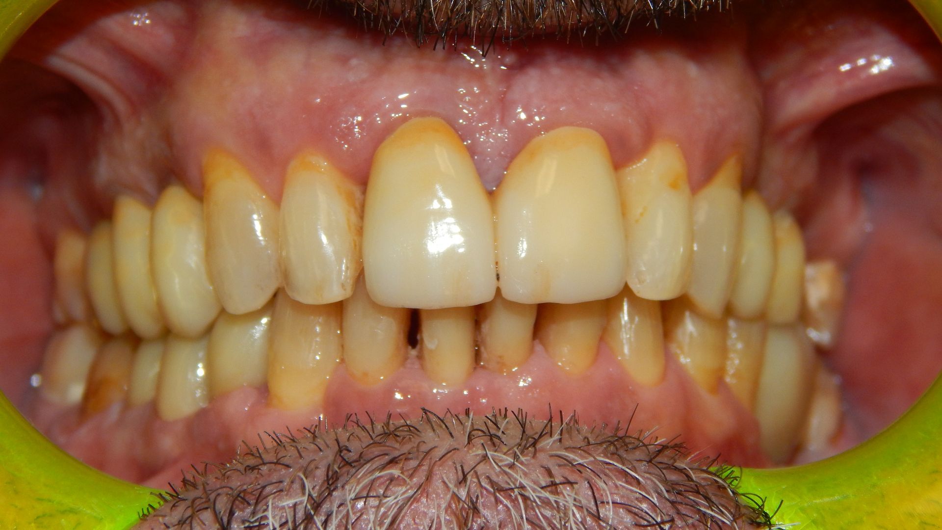 Primo piano della bocca di una persona, con denti e gengive visibili e una corona su un incisivo.