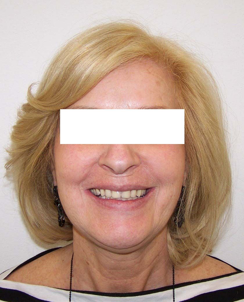 Donna bionda sorridente con una barra bianca che le copre gli occhi, su uno sfondo semplice