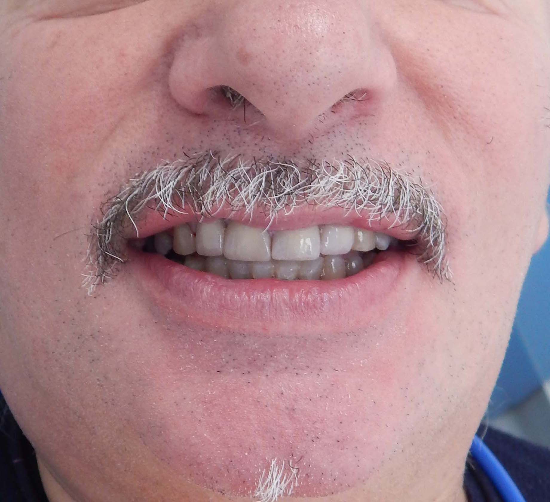 Primo piano di una bocca sorridente con baffi brizzolati e denti visibili