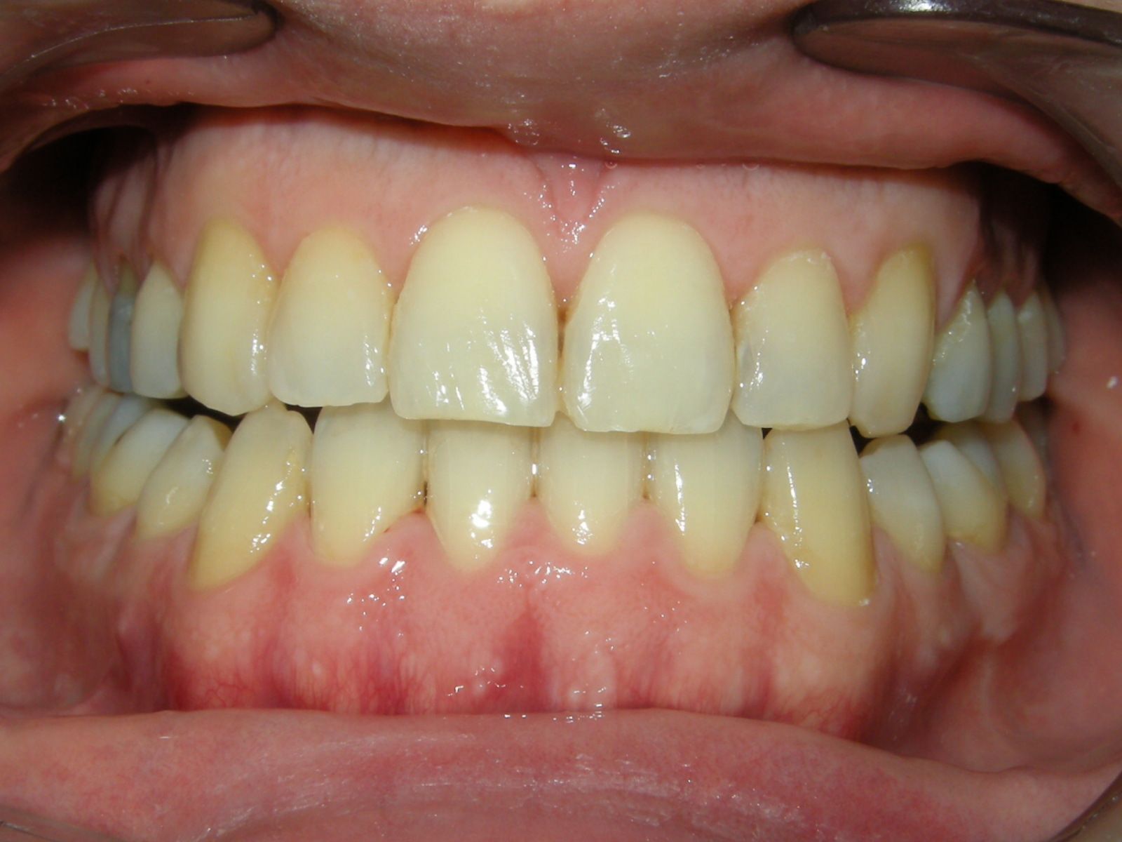 Primo piano di una bocca con denti affollati e discromici visibili