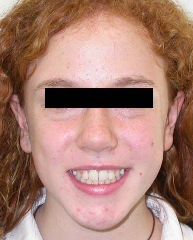 Primo piano di una persona sorridente con i capelli rossi e ricci e una barra nera che copre gli occhi.