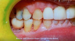 Primo piano di denti e gengive con macchie giallo-marroni e accumulo di placca sul lato inferiore sinistro