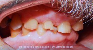 Primo piano di denti disallineati e gengive all’interno di una bocca aperta, con i denti anteriori affollati.