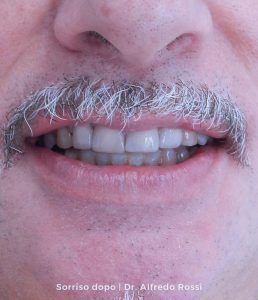 Primo piano di una bocca sorridente con baffi grigi e denti visibili