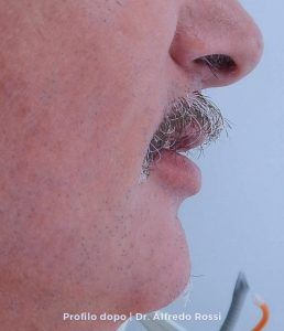 Profilo laterale del volto di un uomo, con il naso e i baffi grigi in evidenza su uno sfondo chiaro.