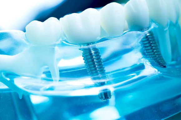 Primo piano di allineatori dentali trasparenti con viti metalliche in un dispositivo ortodontico dalle tonalità blu
