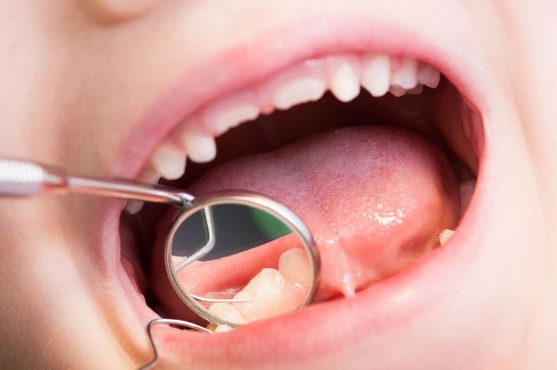 Specchietto dentale che esamina la bocca aperta e i denti durante una visita odontoiatrica