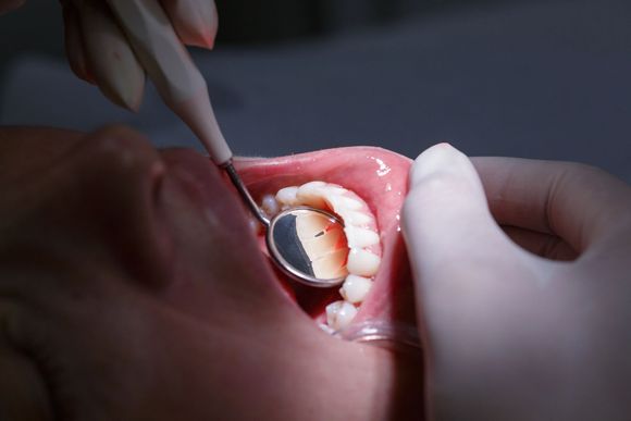Dentista che esamina la bocca aperta di un paziente con uno specchietto dentale e le mani guantate