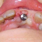 Primo piano delle gengive superiori con un perno implantare lucido tra i denti