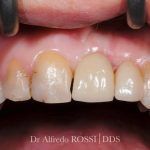 Primo piano di denti anteriori macchiati, con macchie visibili e placca sugli incisivi superiori