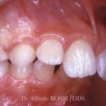 Primo piano dei denti anteriori con uno spazio tra loro e gengive rosa, durante una visita odontoiatrica