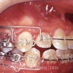 Primo piano di denti con apparecchio metallico e fili ortodontici all’interno della bocca