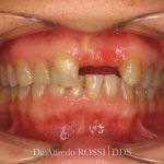 Primo piano di gengive e denti, con tessuto arrossato e infiammato e uno spazio tra i denti anteriori