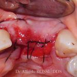 Primo piano del tessuto gengivale suturato, con sangue visibile e denti su entrambi i lati