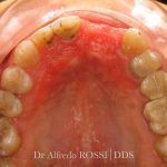 Arcata dentale superiore con palato arrossato e infiammato e molari visibili; primo piano clinico odontoiatrico