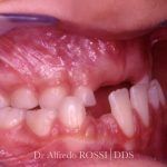 Primo piano dei denti superiori e delle gengive, con una piccola protuberanza bianca sulla gengiva rosa superiore.