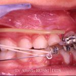 Primo piano di denti con attacchi ortodontici ed elastici all’interno della bocca