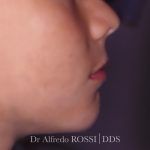 Profilo laterale del viso e del collo di una persona, con mento e linea della mandibola visibili su uno sfondo neutro.