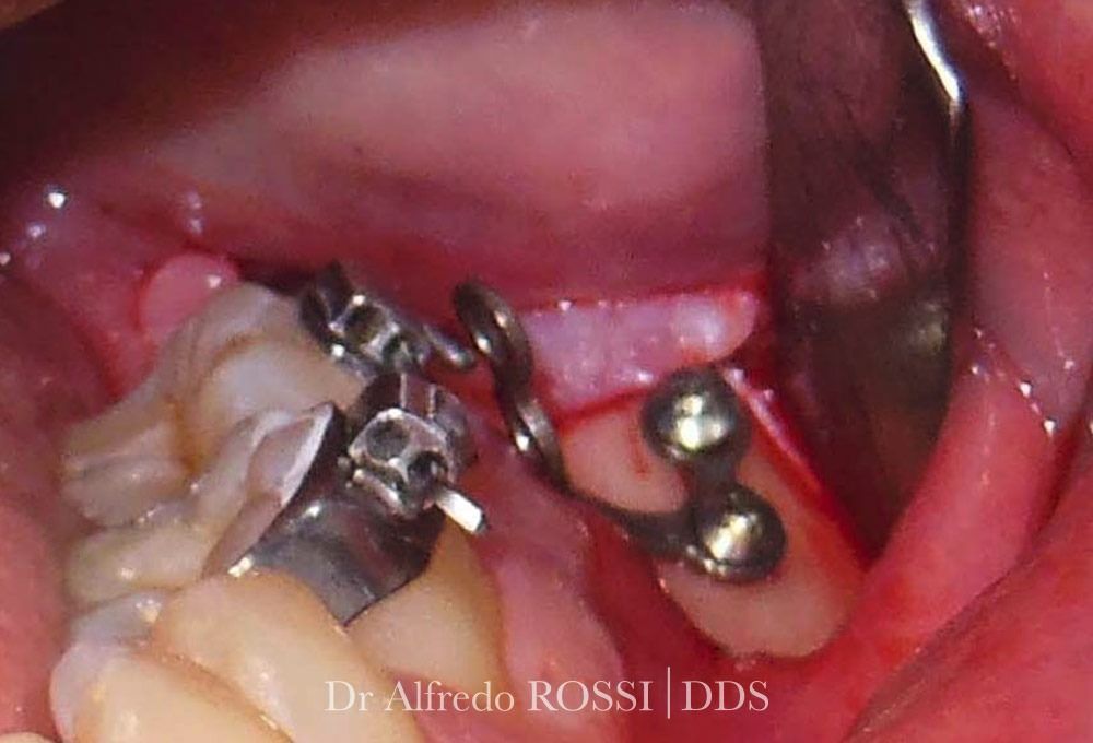 Primo piano di un apparecchio ortodontico e di impianti metallici all’interno della bocca