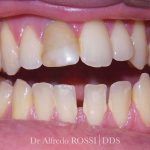 Primo piano di denti con macchie giallastre e piccoli spazi tra un dente e l’altro, con una filigrana odontoiatrica in basso a destra