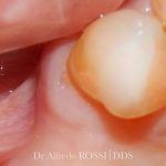 Primo piano di un molare esaminato con uno strumento odontoiatrico all’interno della bocca.