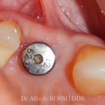Primo piano dentale di un molare con un attacco ortodontico metallico sulle gengive rosa