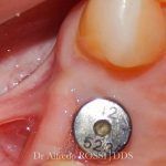 Primo piano di un dente con un attacco ortodontico metallico e gengiva arancione