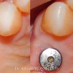 Primo piano dei denti con un moncone implantare in argento visibile lungo il margine gengivale.