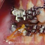 Primo piano di denti con apparecchio metallico e legature elastiche arancioni all’interno della bocca