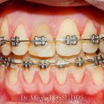 Primo piano di denti con apparecchio ortodontico metallico superiore e inferiore e gengive rosa